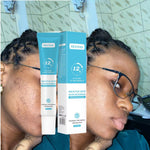 Charger l'image dans la galerie, Gel Anti-Acné MOOYAM-Élimine les Impuretés Réduction Visible des Boutons - Lunarexe ®
